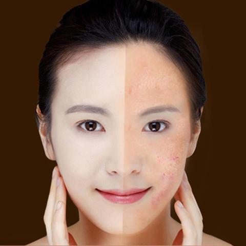 Scar Wrinkle Removal Treatment Device Skin Care